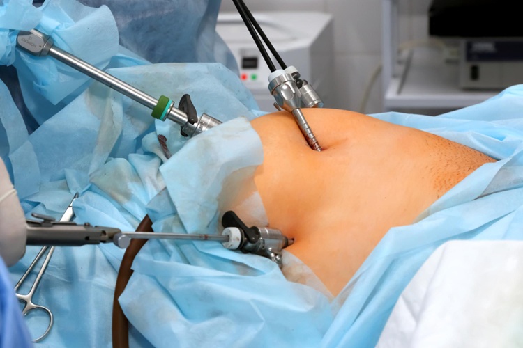 Do I Really Need a Laparoscopy? An Honest Answer